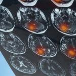 Mengenal 5 Jenis Brain Tumor Treatment Surabaya